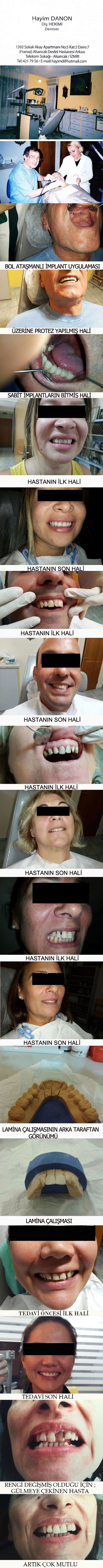 HAYİM DANON-İZMİR DİŞ HEKİMİ-ALSANCAK DİŞ HEKİMİ-İZMİR,LAMİNA ,PORSELEN KAPLAMA -DİŞ BEYAZLATMA