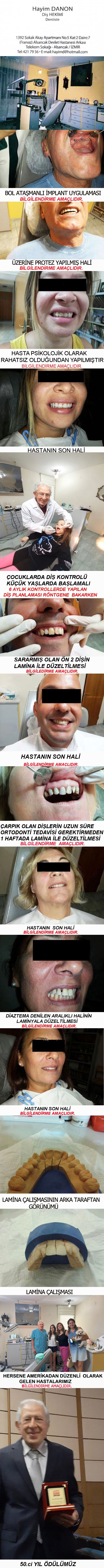 HAYİM DANON-İZMİR DİŞ HEKİMİ-ALSANCAK DİŞ HEKİMİ-İZMİR,LAMİNA ,PORSELEN KAPLAMA -DİŞ BEYAZLATMA